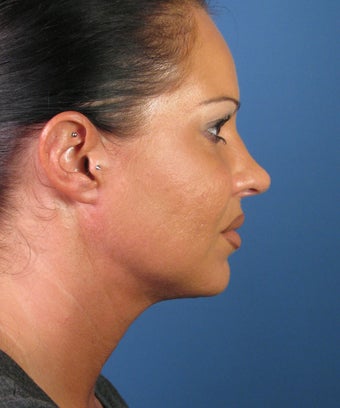 Liposuction 446439