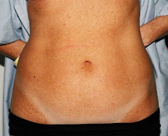 Mini-abdominoplasty before 493653