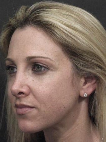 Sculptra 324802