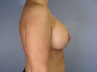 Breast Lift / Breast Augmentation after 290989