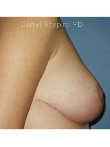 Breast Reduction after 250005