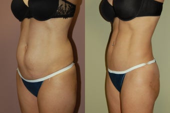 Tummy Tuck before 368140