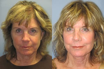 Lite Lift, Brow Lift, Neck Lift, Eyelid Lift, Blue Peel after 523329
