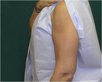 Liposuction of the arms 589893