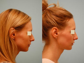 Injectable Fillers (Restylane/Perlane) before 136777