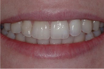 INVISALIGN after 257923