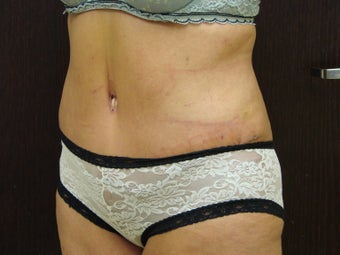 abdominoplasty, liposuction after 597251