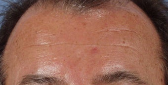 Botox to forehead after 240866
