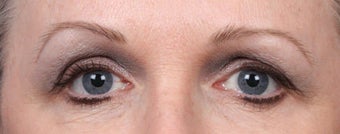 Botox and Dysport after 539897
