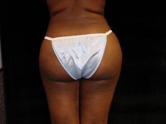 Buttocks Augmentation by Fat Grafting after 157756