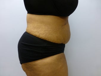 Mini Tummy Tuck and liposuction 590774
