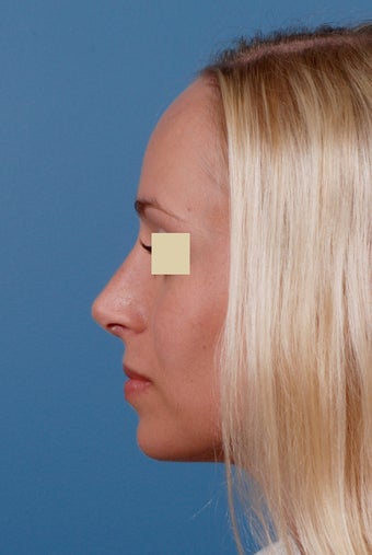 Rhinoplasty Before and After after 146623
