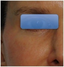 TCA Peel - Lower Lids after 70908
