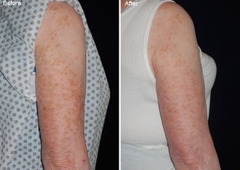 Fraxel laser resurfacing before 97763