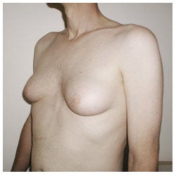 Periareolar Excision Gynecomastia / Liposuction before 334404