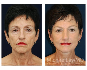 Facial Rejuvenation before 395250