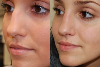 Non-Surgical Rhinoplasty with Silikon-1000 before 257687