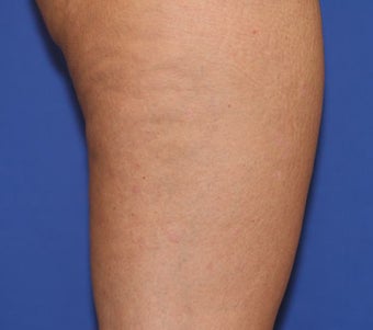VASER Shape to Legs after 433061