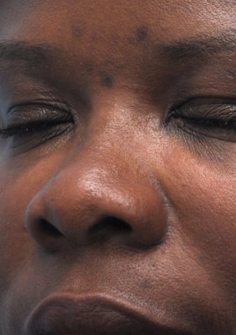Non Surgical Rhinoplasty 407865