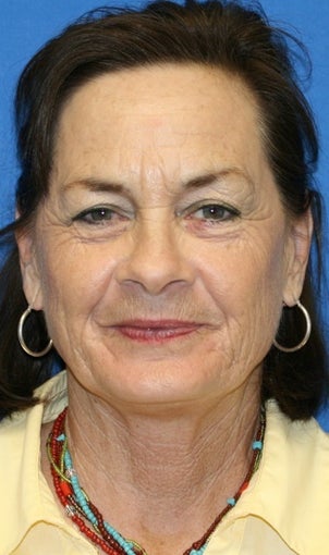 6 months post op: Facelift, Fat Transfer, Upper Bleph., Skin Pinch, & Chemical Peel before 424205
