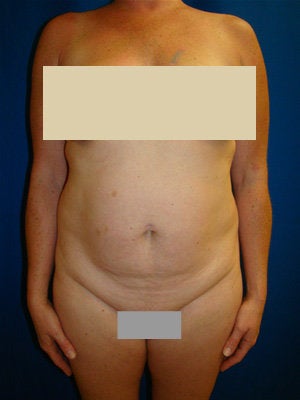 Tummy Tuck Surgery (abdominoplasty) before 142009