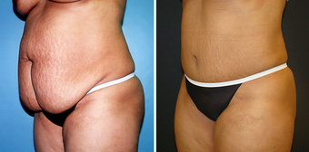 Tummy Tuck (Abdominoplasty) with Liposuction before 262729