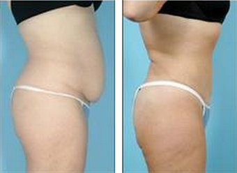 Tummy Tuck (Abdominoplasty) 324853
