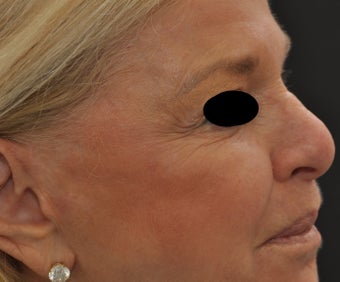 TCA Full-Face Chemical Peel after 182431