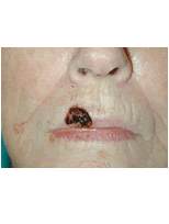 Lip skin cancer reconstruction before 84503