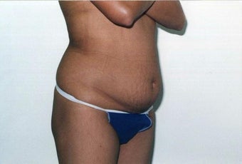 Tummy Tuck before 215127