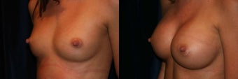 Breast Augmentation 382853