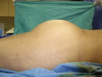 Butt Augmentation, Liposuction after 402324