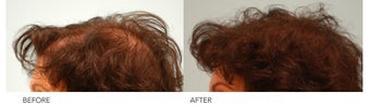 Female Hair Transplant before 144075