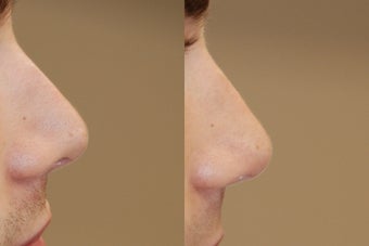 Non-Surgical Rhinoplasty using Silikon-1000 before 160630