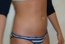 Liposuction of Abdomen after 149286