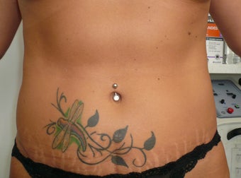 Abdominoplasty after 163980