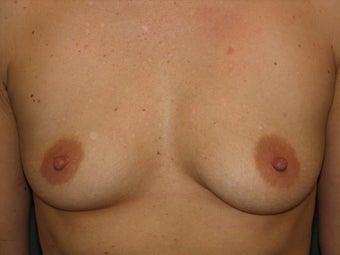 Breast Augmentation before 384406