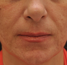 Acne Scarring after 426030