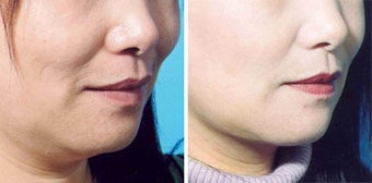 Chin Liposuction before 640680