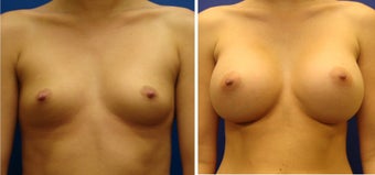 Breast Augmentation before 240531
