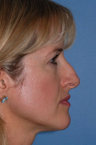 Rhinoplasty before 87108