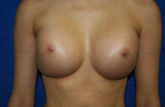 Breast implants after 241854