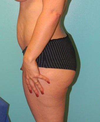 Brazilian Butt Lift- Fat transfer 372611
