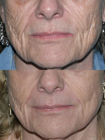 Fraxel repair with C02/Erbium lasers for upper lip wrinkles before 104308
