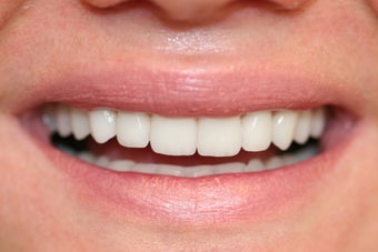veneer and crown work after 558816