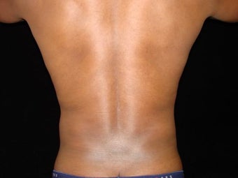 Liposuction of Abdomen, Waist, Flanks with 6 Pack Abdominal Etching after 203527