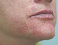 Chin rejuvenation after 91308