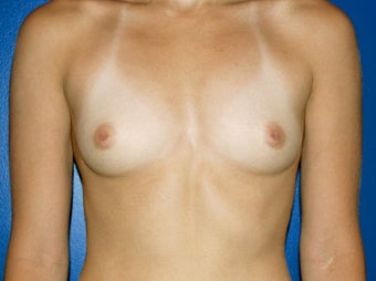 Silicone Breast Augmentation before 239076