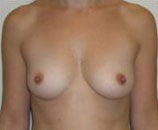 Breast Augmentation before 142509