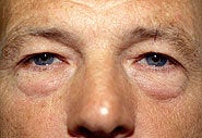 Before and After Blepharoplasty and Brow Lift before 87332